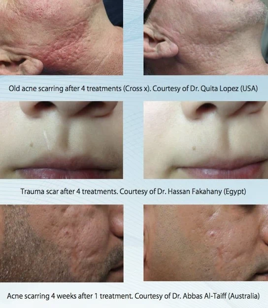 Before/after resultater etter Dermapen microneedling-behandling av arr og hudtekstur